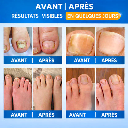 Patchs Antifongiques Podovia™ | Élimine les mycoses des ongles pendant votre sommeil